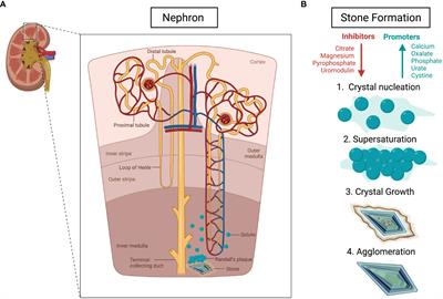 Frontiers | Monogenic causation of pediatric nephrolithiasis